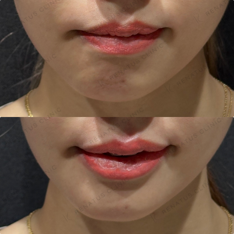 上唇・Cカール・下唇ヒアルロン酸ボルベラ症例写真