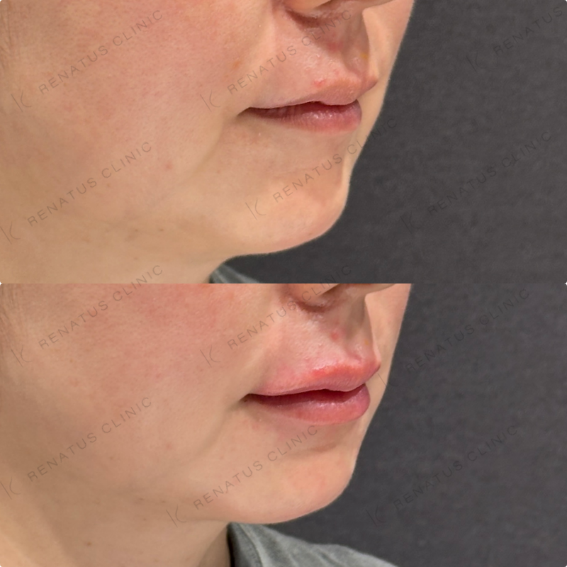 上唇・Cカール・下唇ヒアルロン酸ボルベラ症例写真