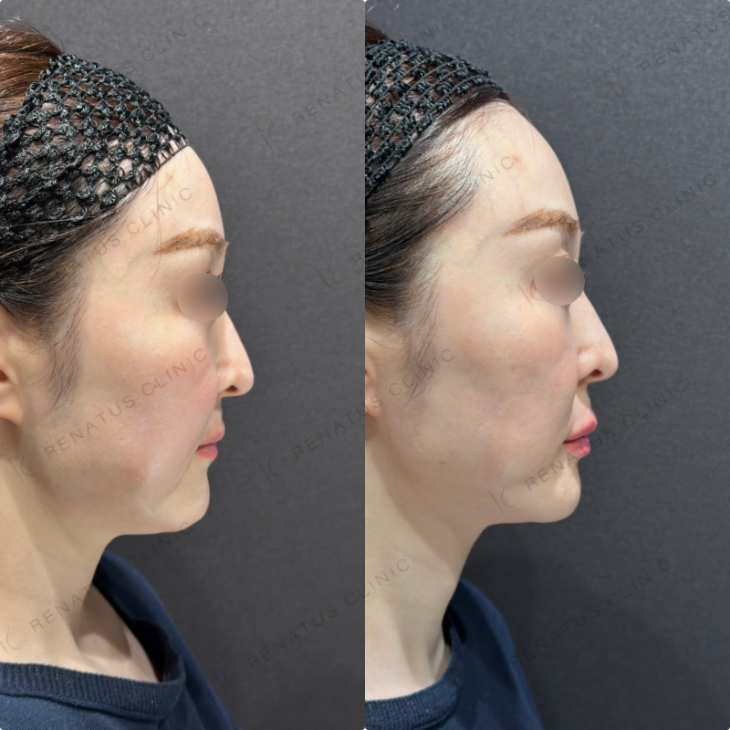 上唇・Cカール・下唇ヒアルロン酸ボルベラ症例写真