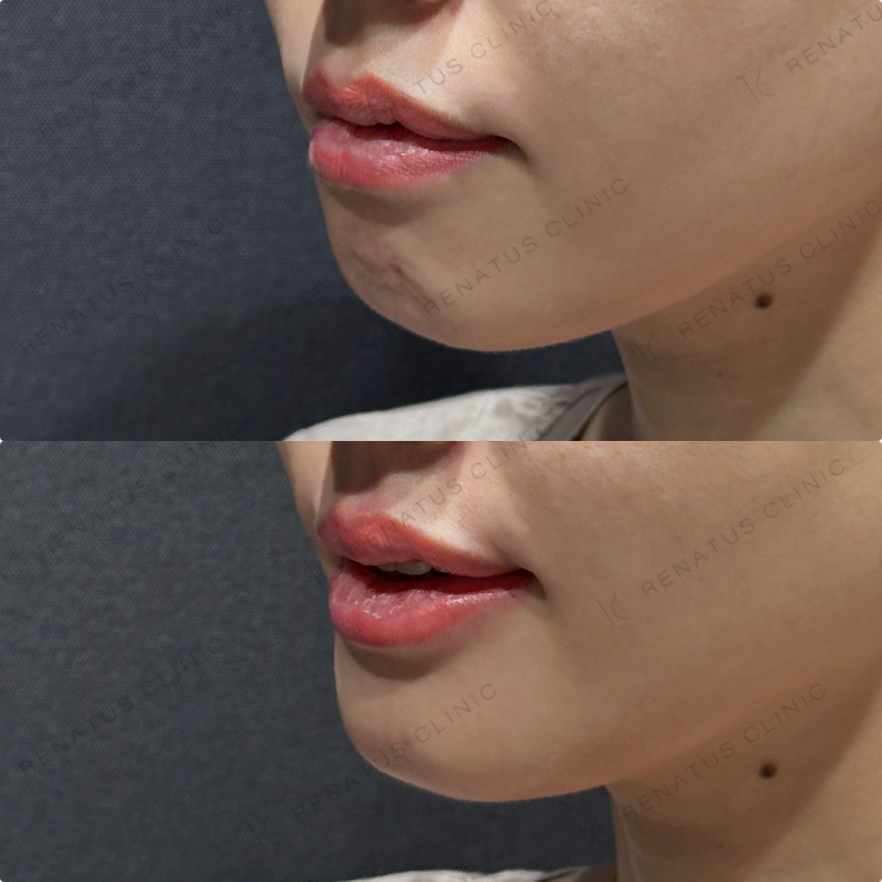 上唇・Cカール・下唇ヒアルロン酸ボルベラ症例写真