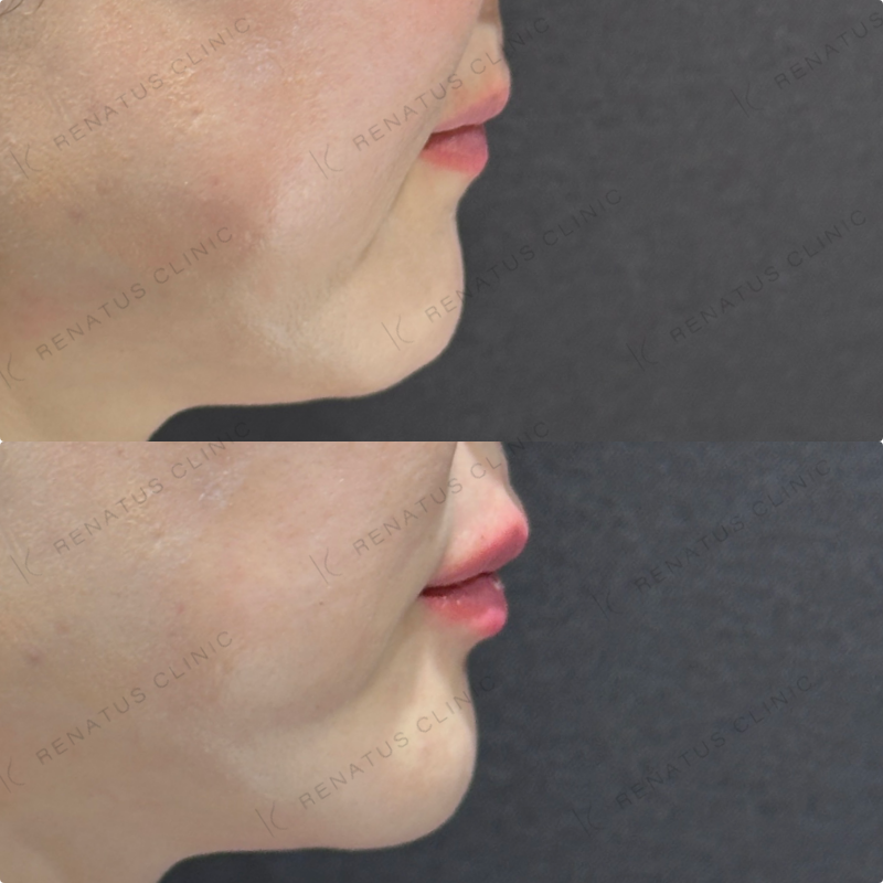 上唇・Cカール・下唇ヒアルロン酸ボルベラ症例写真