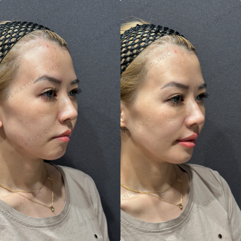 上唇・Cカール・下唇ヒアルロン酸ボルベラ症例写真