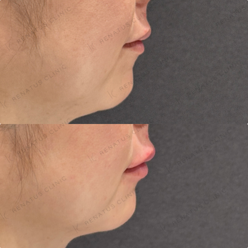 上唇・Cカール・下唇ヒアルロン酸ボルベラ症例写真