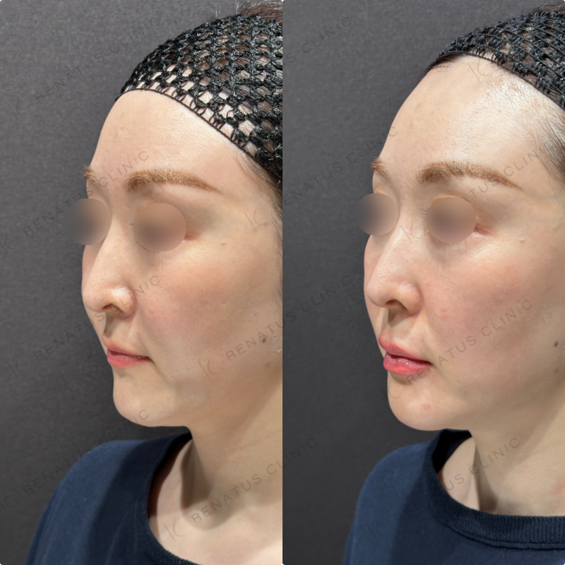 上唇・Cカール・下唇ヒアルロン酸ボルベラ症例写真