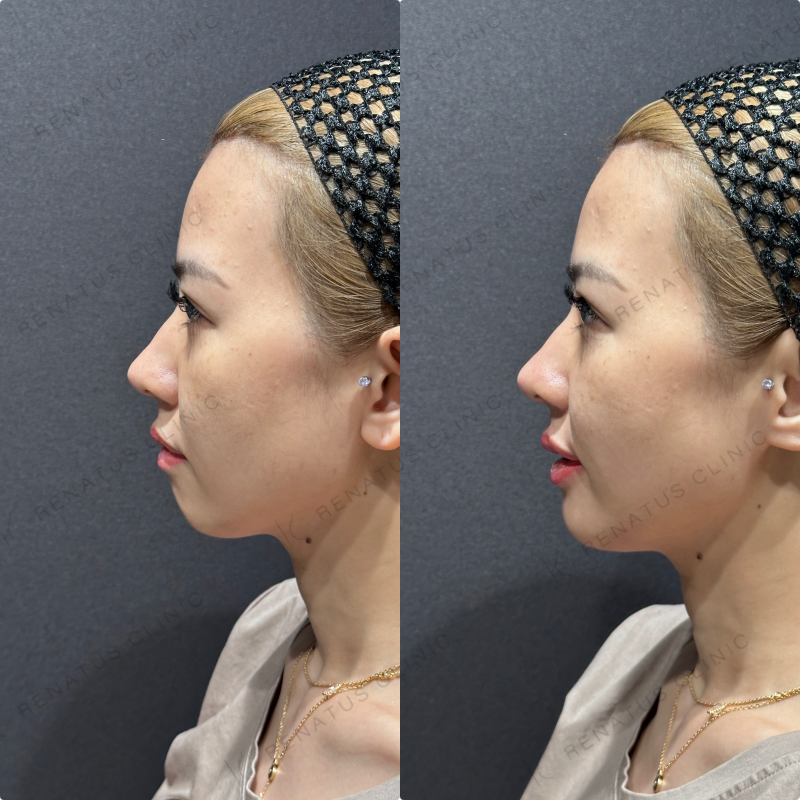 上唇・Cカール・下唇ヒアルロン酸ボルベラ症例写真