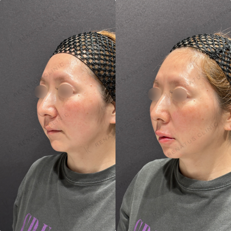 上唇・Cカール・下唇ヒアルロン酸ボルベラ症例写真