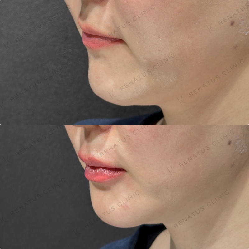 上唇・Cカール・下唇ヒアルロン酸ボルベラ症例写真