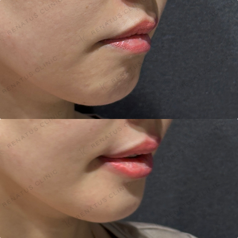 上唇・Cカール・下唇ヒアルロン酸ボルベラ症例写真