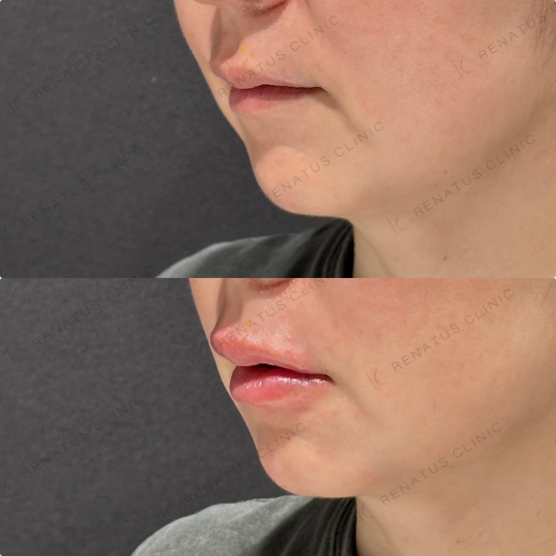 上唇・Cカール・下唇ヒアルロン酸ボルベラ症例写真