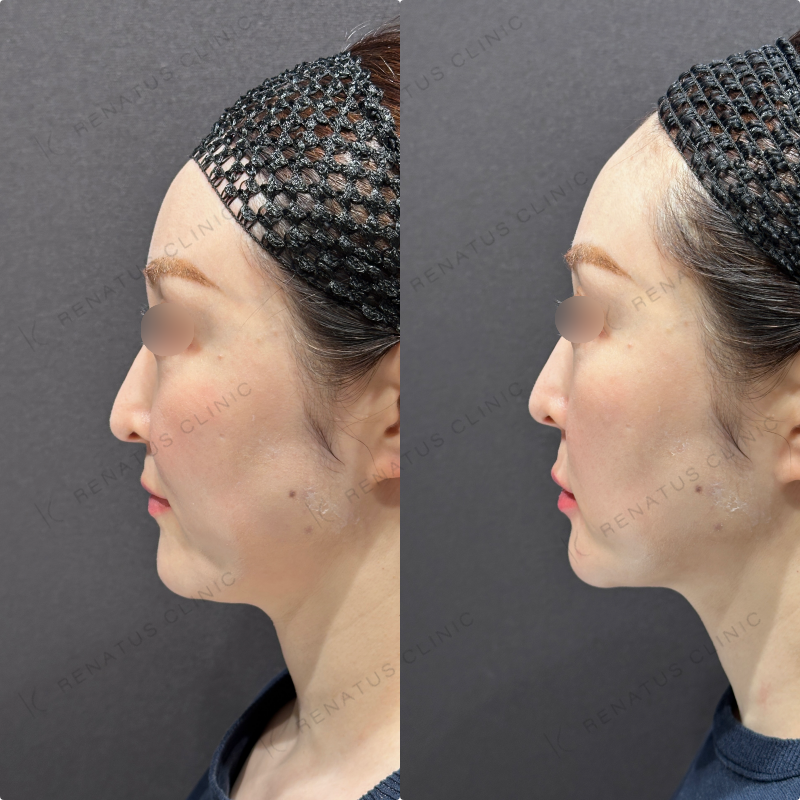 上唇・Cカール・下唇ヒアルロン酸ボルベラ症例写真