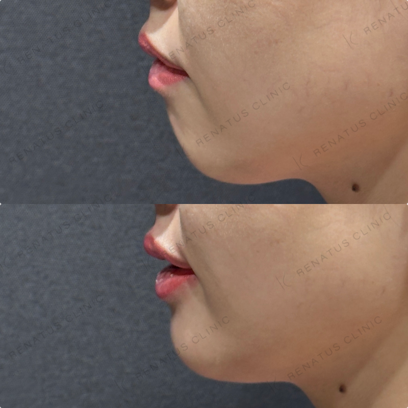 上唇・Cカール・下唇ヒアルロン酸ボルベラ症例写真