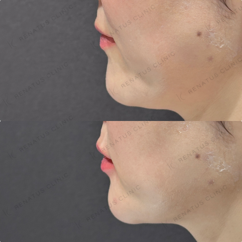 上唇・Cカール・下唇ヒアルロン酸ボルベラ症例写真