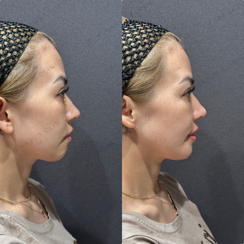 上唇・Cカール・下唇ヒアルロン酸ボルベラ症例写真