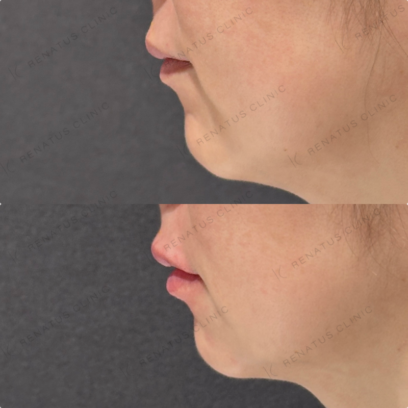 上唇・Cカール・下唇ヒアルロン酸ボルベラ症例写真