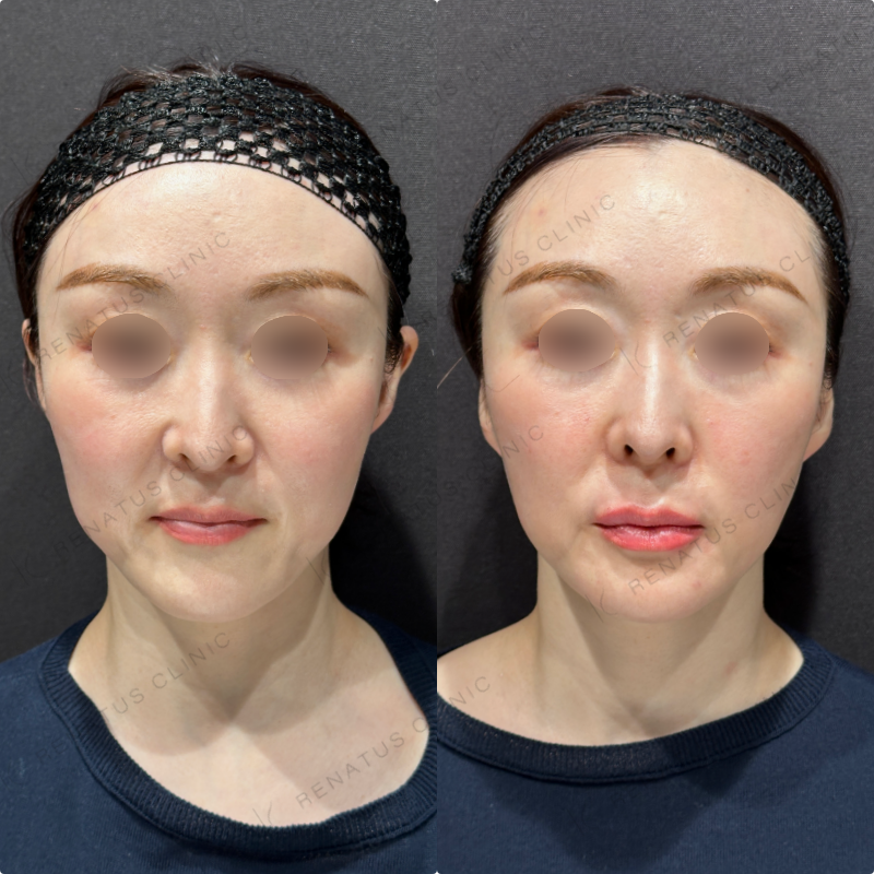 上唇・Cカール・下唇ヒアルロン酸ボルベラ症例写真