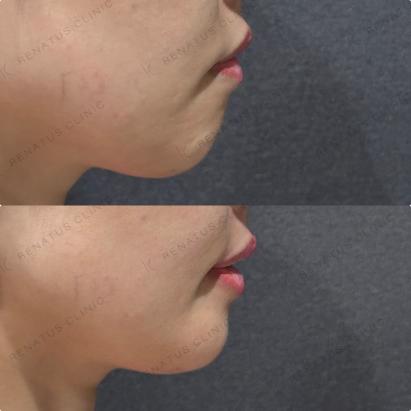 上唇・Cカール・下唇ヒアルロン酸ボルベラ症例写真