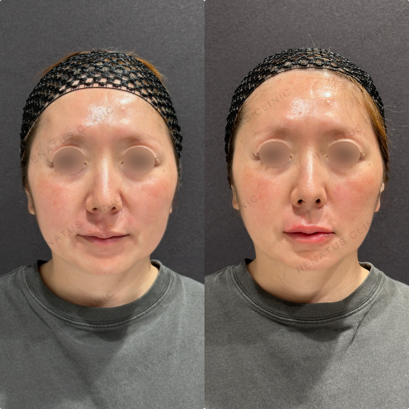 上唇・Cカール・下唇ヒアルロン酸ボルベラ症例写真