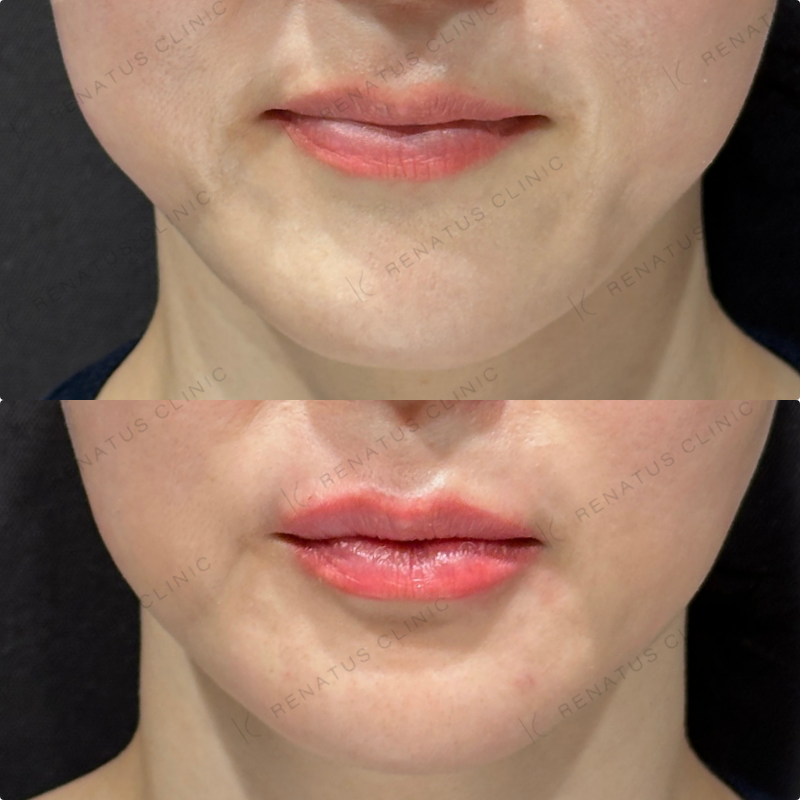 上唇・Cカール・下唇ヒアルロン酸ボルベラ症例写真