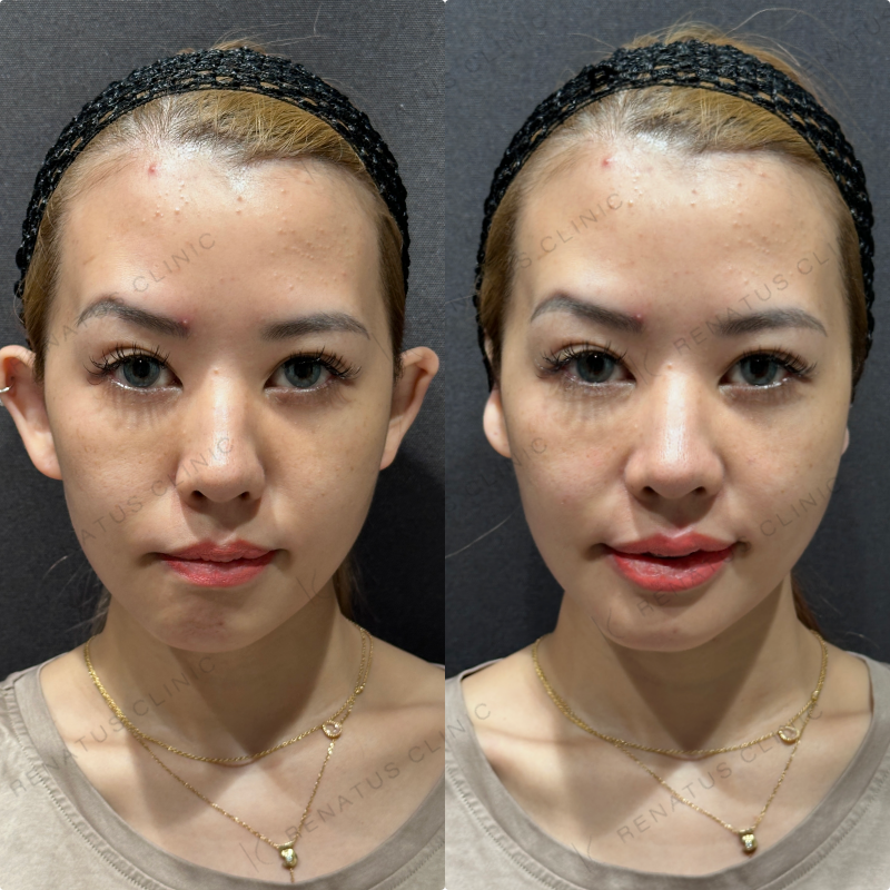 上唇・Cカール・下唇ヒアルロン酸ボルベラ症例写真