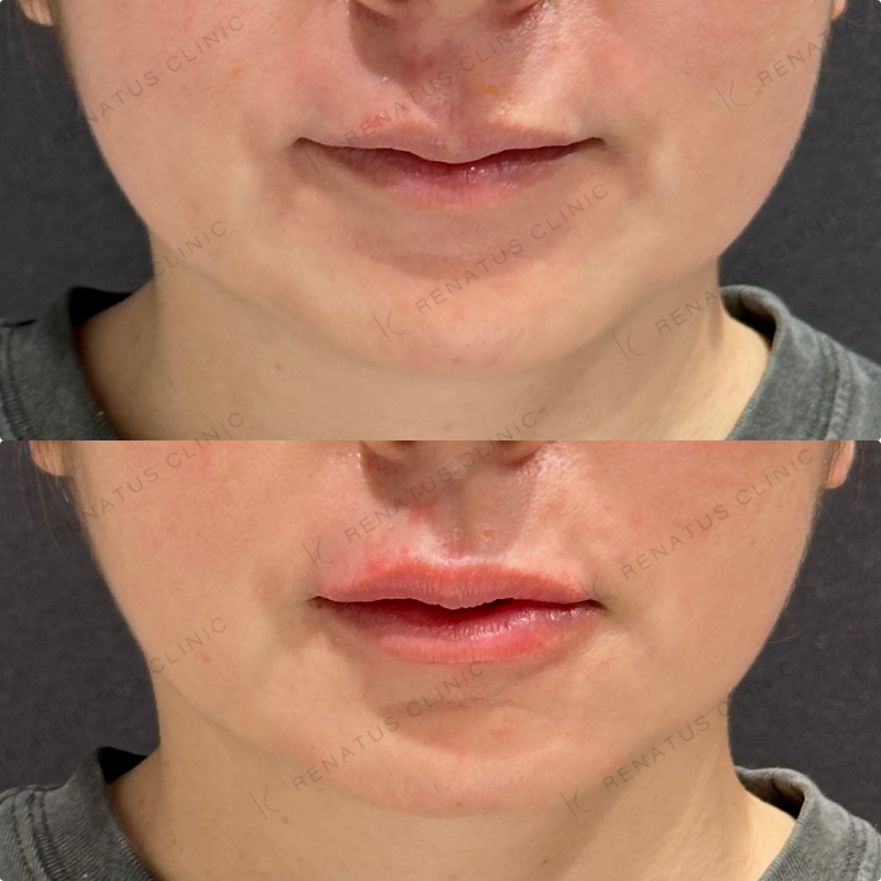 上唇・Cカール・下唇ヒアルロン酸ボルベラ症例写真