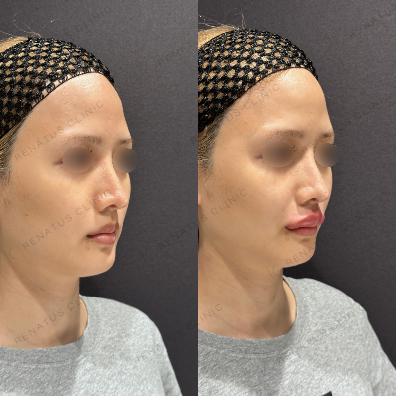 上唇・Cカールヒアルロン酸ボルベラ症例写真