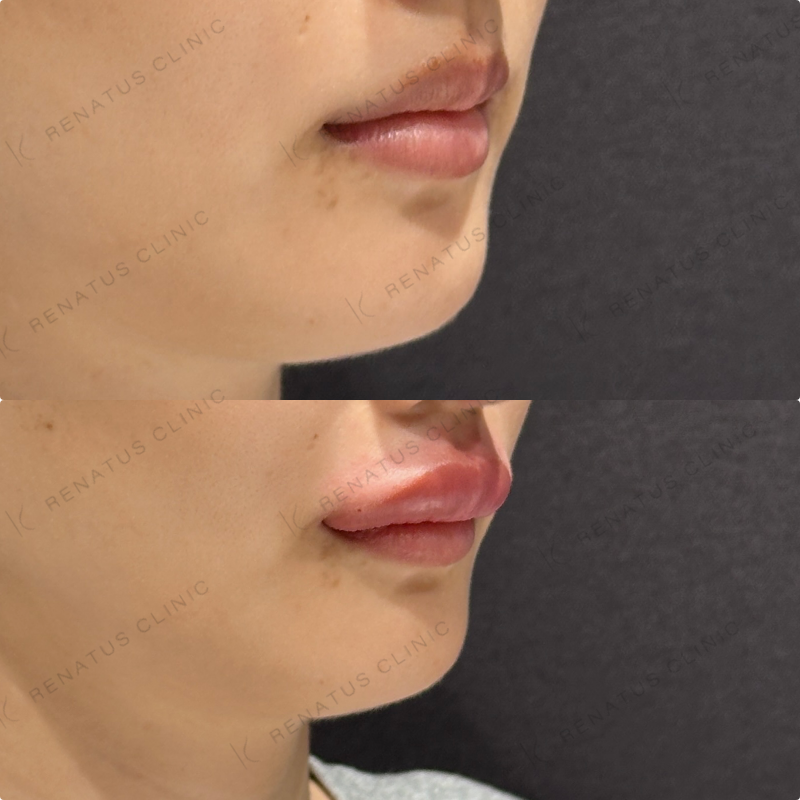 上唇・Cカールヒアルロン酸ボルベラ症例写真