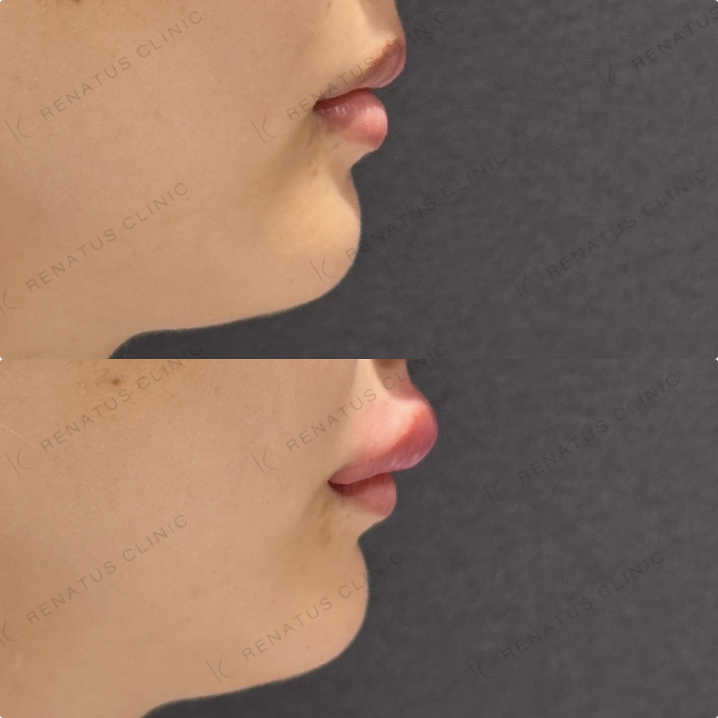 上唇・Cカールヒアルロン酸ボルベラ症例写真