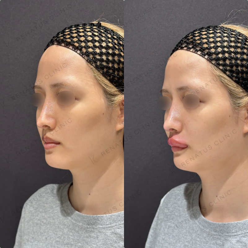 上唇・Cカールヒアルロン酸ボルベラ症例写真