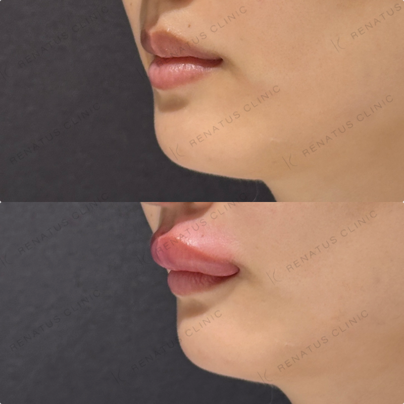 上唇・Cカールヒアルロン酸ボルベラ症例写真