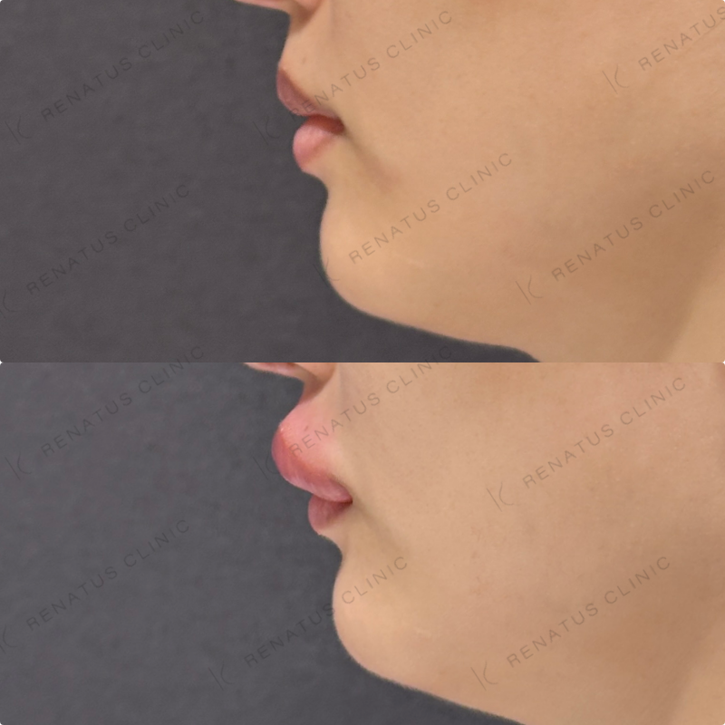 上唇・Cカールヒアルロン酸ボルベラ症例写真