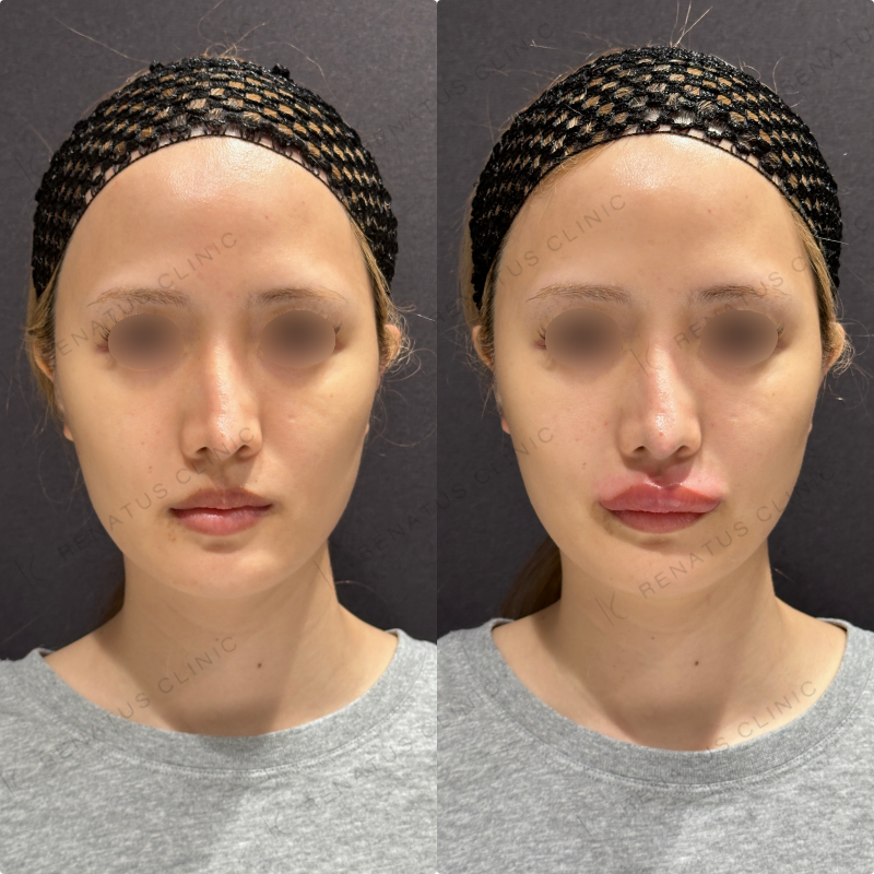 上唇・Cカールヒアルロン酸ボルベラ症例写真