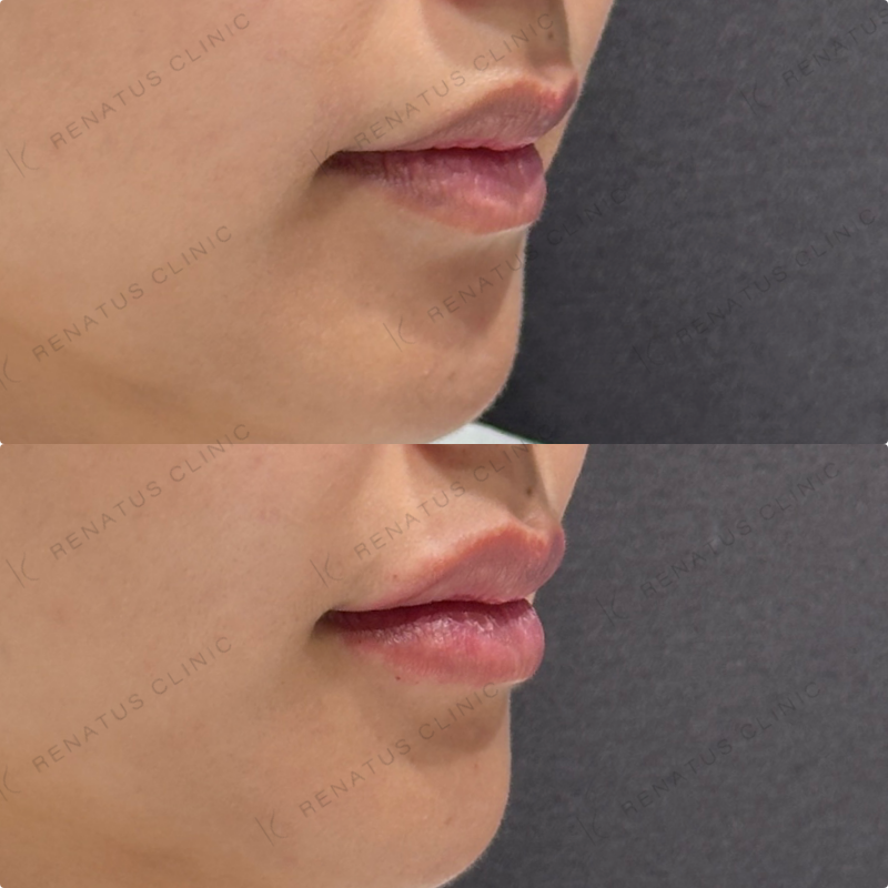 上唇・Cカール・下唇ヒアルロン酸ボルベラ症例写真