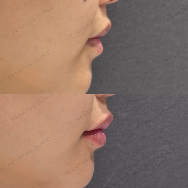 上唇・Cカール・下唇ヒアルロン酸ボルベラ症例写真