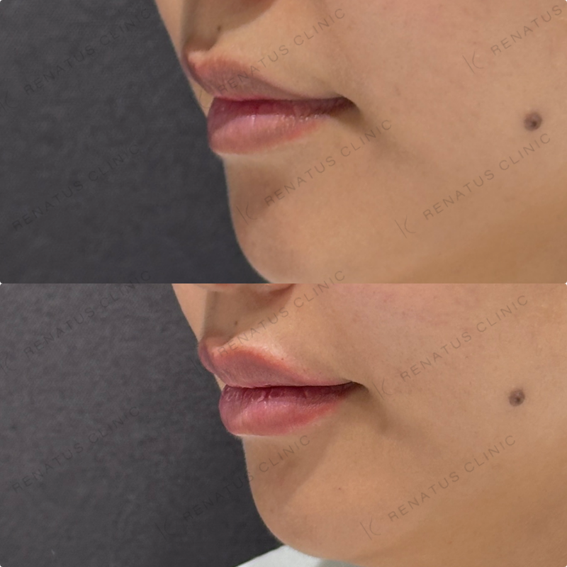 上唇・Cカール・下唇ヒアルロン酸ボルベラ症例写真