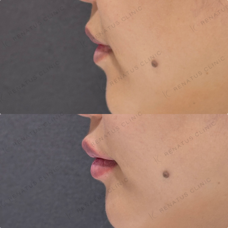 上唇・Cカール・下唇ヒアルロン酸ボルベラ症例写真