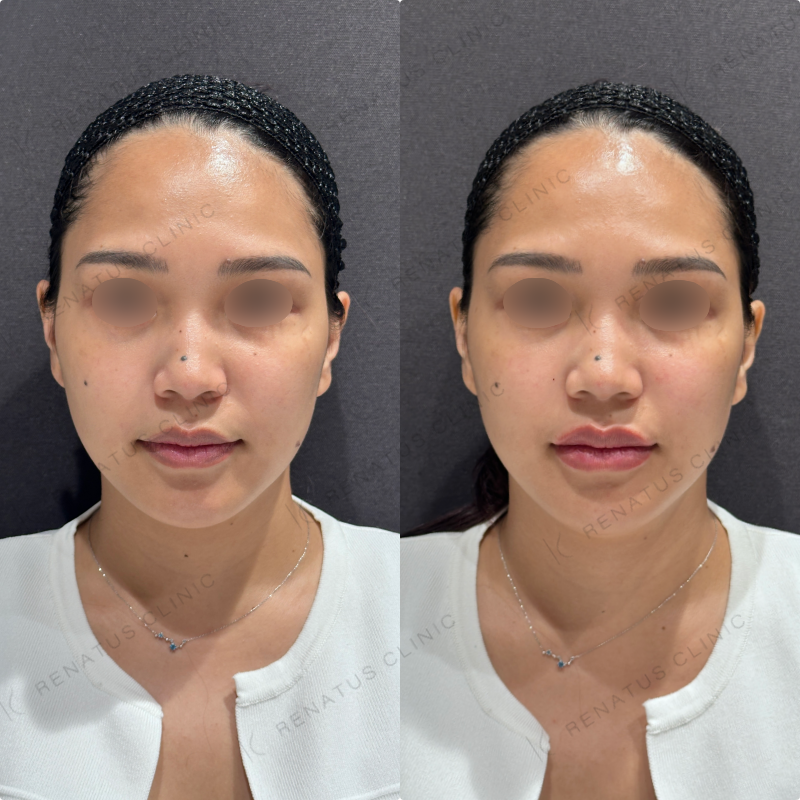 上唇・Cカール・下唇ヒアルロン酸ボルベラ症例写真