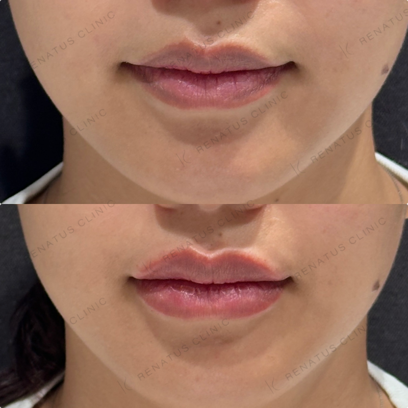 上唇・Cカール・下唇ヒアルロン酸ボルベラ症例写真