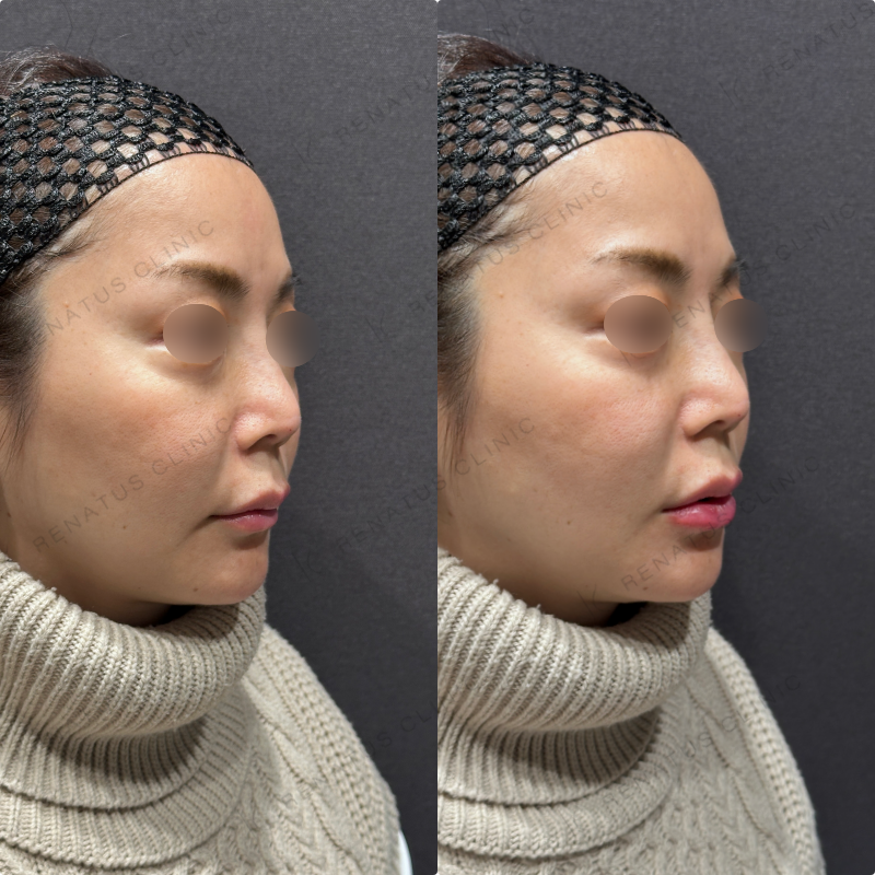 下唇ヒアルロン酸ボルベラ症例写真