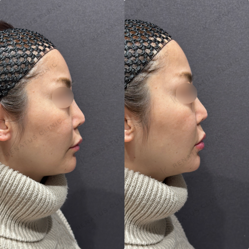 下唇ヒアルロン酸ボルベラ症例写真