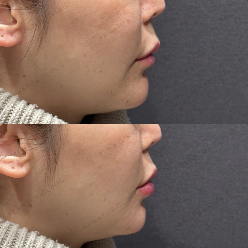 下唇ヒアルロン酸ボルベラ症例写真