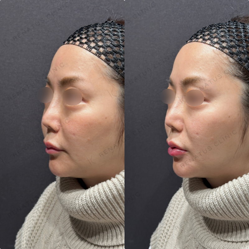 下唇ヒアルロン酸ボルベラ症例写真