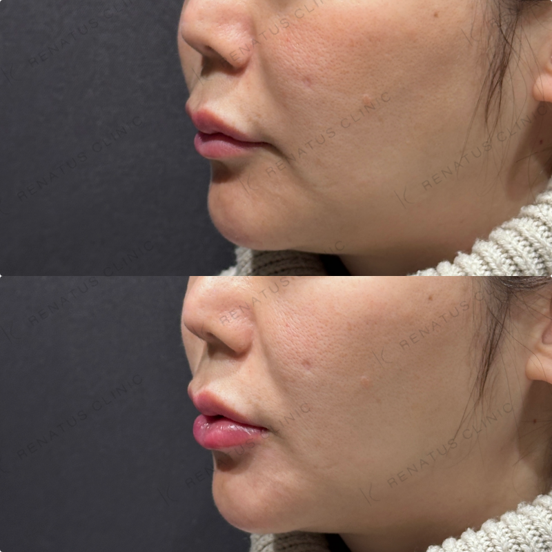 下唇ヒアルロン酸ボルベラ症例写真