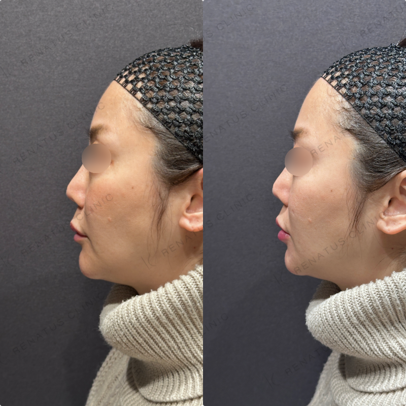 下唇ヒアルロン酸ボルベラ症例写真