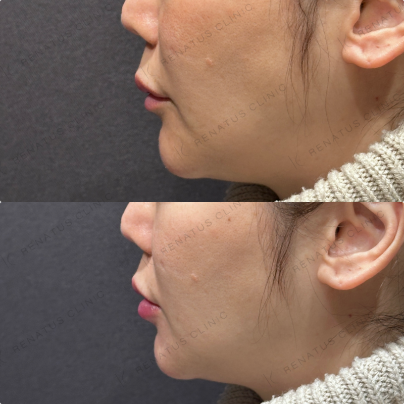 下唇ヒアルロン酸ボルベラ症例写真