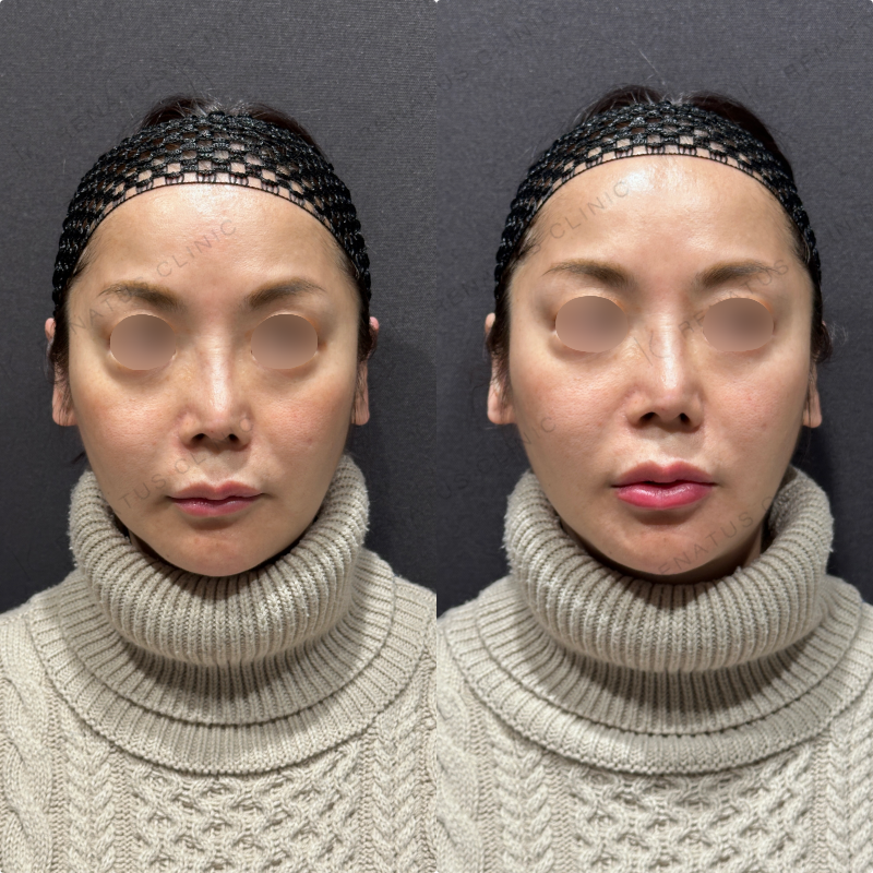 下唇ヒアルロン酸ボルベラ症例写真