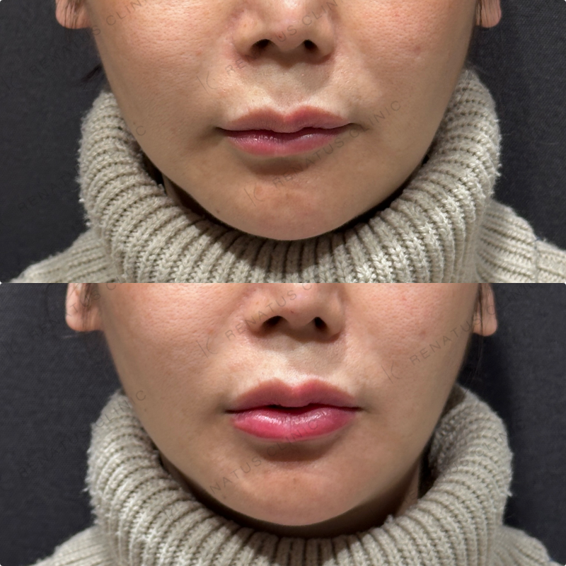 下唇ヒアルロン酸ボルベラ症例写真