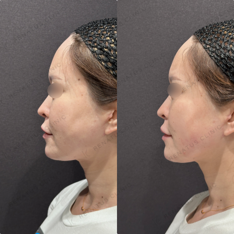 左頬コケヒアルロン酸ボリフト症例写真