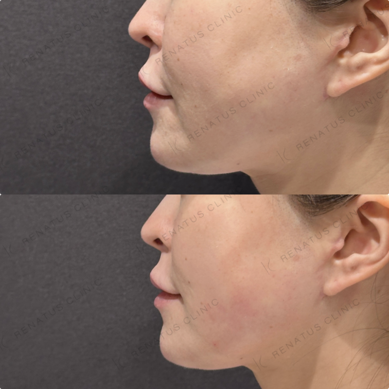 左頬コケヒアルロン酸ボリフト症例写真