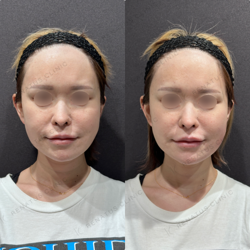 左頬コケヒアルロン酸ボリフト症例写真