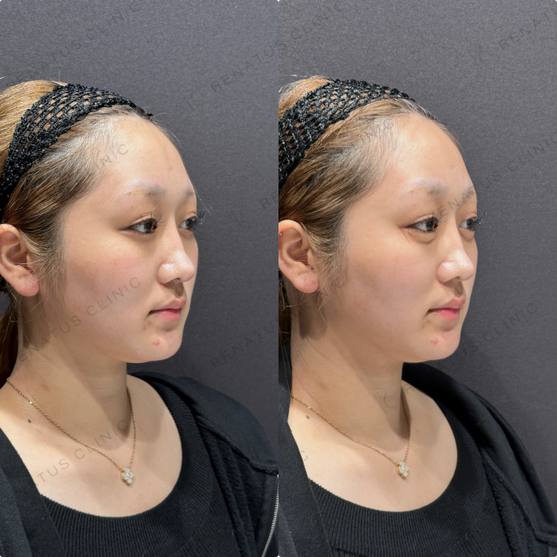 涙袋ヒアルロン酸ボルベラ症例写真